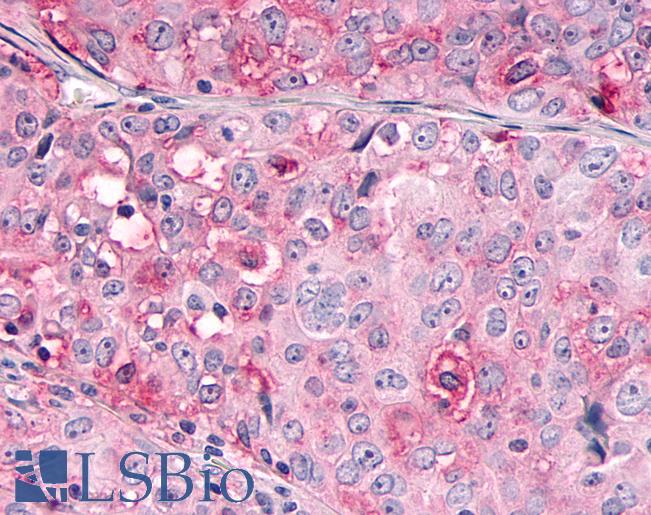 Anti-OR10R2 antibody IHC of human Ovary, Carcinoma. Immunohistochemistry of formalin-fixed, paraffin-embedded tissue after heat-induced antigen retrieval.
