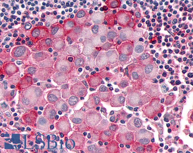 Anti-OR10R2 antibody IHC of human Skin, Melanoma. Immunohistochemistry of formalin-fixed, paraffin-embedded tissue after heat-induced antigen retrieval.