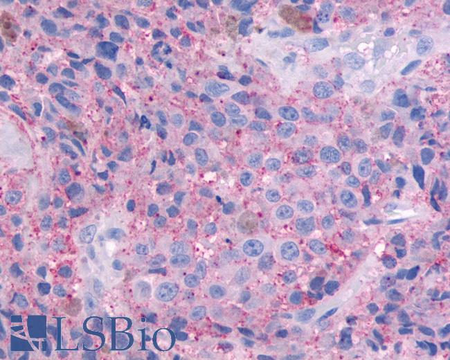 Anti-OR51E1 antibody IHC of human Skin, Melanoma. Immunohistochemistry of formalin-fixed, paraffin-embedded tissue after heat-induced antigen retrieval.