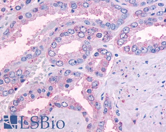 Anti-OR51E1 antibody IHC of human Prostate, Carcinoma. Immunohistochemistry of formalin-fixed, paraffin-embedded tissue after heat-induced antigen retrieval.