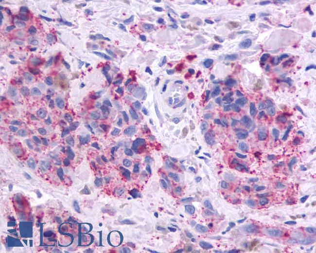 Anti-OR51E1 antibody IHC of human Skin, Melanoma. Immunohistochemistry of formalin-fixed, paraffin-embedded tissue after heat-induced antigen retrieval.