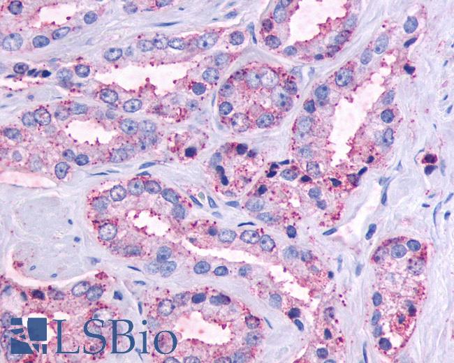 Anti-OR51E1 antibody IHC of human Prostate, Carcinoma. Immunohistochemistry of formalin-fixed, paraffin-embedded tissue after heat-induced antigen retrieval.