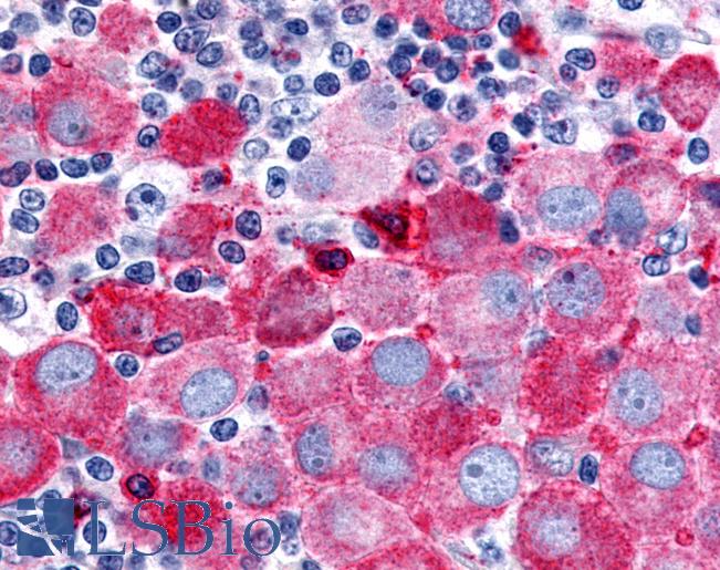 Anti-OR51E2 / PSGR antibody IHC of human Skin, Melanoma. Immunohistochemistry of formalin-fixed, paraffin-embedded tissue after heat-induced antigen retrieval.