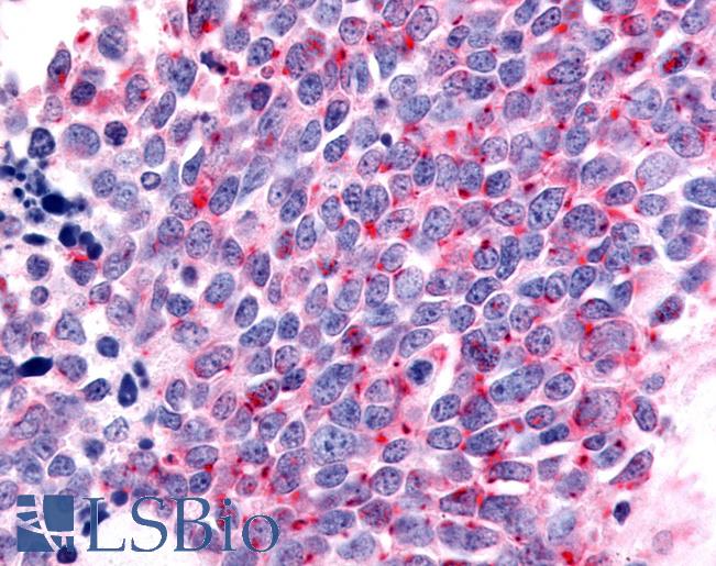 Anti-OR6K3 antibody IHC of human Lung, Small Cell Carcinoma. Immunohistochemistry of formalin-fixed, paraffin-embedded tissue after heat-induced antigen retrieval.