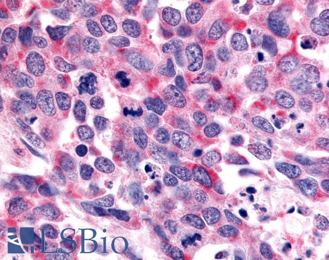 Anti-OR6K3 antibody IHC of human Lung, Small Cell Carcinoma. Immunohistochemistry of formalin-fixed, paraffin-embedded tissue after heat-induced antigen retrieval.