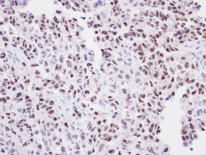 IHC of paraffin-embedded CL1-0 Xenograft using ORC2 antibody at 1:100 dilution.