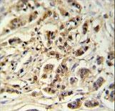 M11D1 Antibody IHC of formalin-fixed and paraffin-embedded breast carcinoma followed by peroxidase-conjugated secondary antibody and DAB staining.