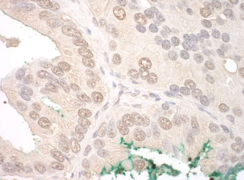Detection of Human ORC2 by Immunohistochemistry. Sample: FFPE section of human prostate carcinoma. Antibody: Affinity purified rabbit anti-ORC2 used at a dilution of 1:1000 (0.2 ug/mg).
