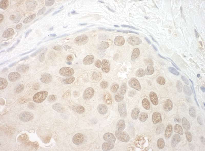 Detection of Human ORC2 by Immunohistochemistry. Sample: FFPE section of human breast carcinoma. Antibody: Affinity purified rabbit anti-ORC2 used at a dilution of 1:200 (1 ug/mg).