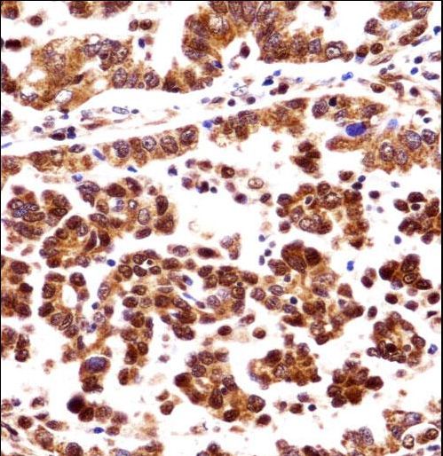 ORC3L Antibody immunohistochemistry of formalin-fixed and paraffin-embedded human lung adenocarcinoma followed by peroxidase-conjugated secondary antibody and DAB staining.