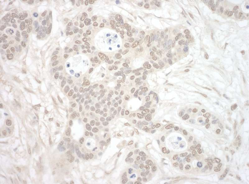 Detection of Human ORC3 by Immunohistochemistry. Sample: FFPE section of human breast carcinoma. Antibody: Affinity purified rabbit anti-ORC3 used at a dilution of 1:200 (1 ug/mg).
