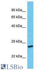ORC6 / ORC6L antibody Western Blot of Thyroid Tumor. Antibody dilution: 1 ug/ml.