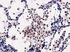 IHC of paraffin-embedded Carcinoma of Human lung tissue using anti-OSBPL11 mouse monoclonal antibody.
