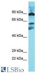 METTL16 / METT10D antibody Western Blot of Esophagus Tumor. Antibody dilution: 1 ug/ml.