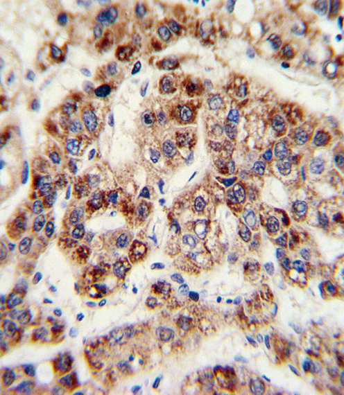 Formalin-fixed and paraffin-embedded human hepatocarcinoma with OTC Antibody , which was peroxidase-conjugated to the secondary antibody, followed by DAB staining. This data demonstrates the use of this antibody for immunohistochemistry; clinical relevance has not been evaluated.