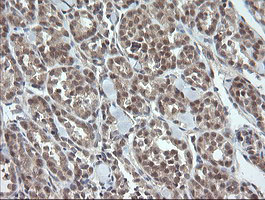 IHC of paraffin-embedded Carcinoma of Human thyroid tissue using anti-OTUB1 mouse monoclonal antibody. (Heat-induced epitope retrieval by 10mM citric buffer, pH6.0, 100C for 10min).