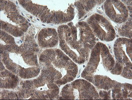 IHC of paraffin-embedded Adenocarcinoma of Human endometrium tissue using anti-OTUB1 mouse monoclonal antibody. (Heat-induced epitope retrieval by 10mM citric buffer, pH6.0, 100C for 10min).