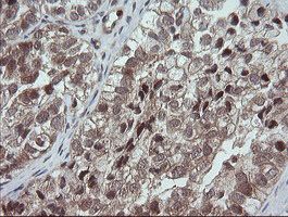 IHC of paraffin-embedded Adenocarcinoma of Human ovary tissue using anti-OTUB1 mouse monoclonal antibody. (Heat-induced epitope retrieval by 10mM citric buffer, pH6.0, 100C for 10min).