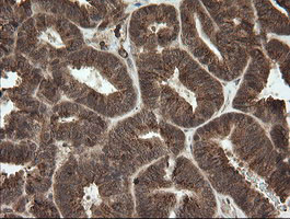 IHC of paraffin-embedded Adenocarcinoma of Human endometrium tissue using anti-OTUB1 mouse monoclonal antibody.