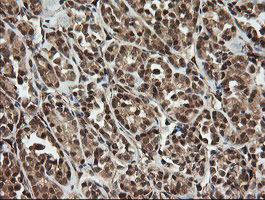 IHC of paraffin-embedded Carcinoma of Human thyroid tissue using anti-OTUB1 mouse monoclonal antibody.