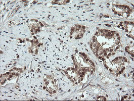 IHC of paraffin-embedded Carcinoma of Human prostate tissue using anti-OTUB1 mouse monoclonal antibody.