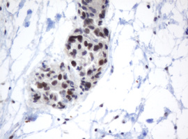 IHC of paraffin-embedded Adenocarcinoma of Human ovary tissue using anti-METT10D mouse monoclonal antibody.