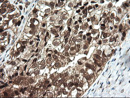 IHC of paraffin-embedded Adenocarcinoma of Human ovary tissue using anti-OTUB1 mouse monoclonal antibody.