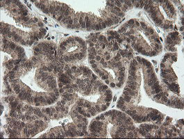IHC of paraffin-embedded Adenocarcinoma of Human endometrium tissue using anti-OTUB1 mouse monoclonal antibody.