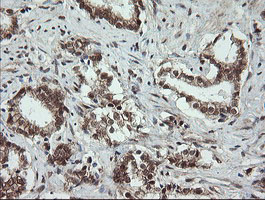 IHC of paraffin-embedded Carcinoma of Human prostate tissue using anti-OTUB1 mouse monoclonal antibody.