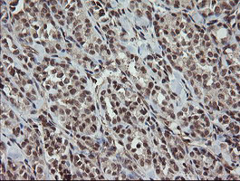 IHC of paraffin-embedded Carcinoma of Human thyroid tissue using anti-OTUB1 mouse monoclonal antibody.