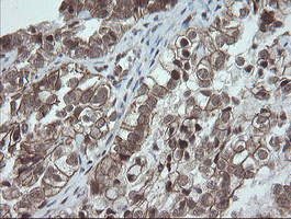 IHC of paraffin-embedded Adenocarcinoma of Human ovary tissue using anti-OTUB1 mouse monoclonal antibody.