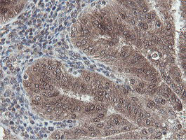 IHC of paraffin-embedded Adenocarcinoma of Human endometrium tissue using anti-OTUB1 mouse monoclonal antibody.