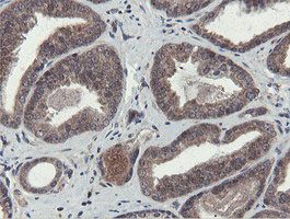 IHC of paraffin-embedded Carcinoma of Human prostate tissue using anti-OTUB1 mouse monoclonal antibody.