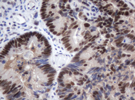 IHC of paraffin-embedded Adenocarcinoma of Human colon tissue using anti-METT10D mouse monoclonal antibody.
