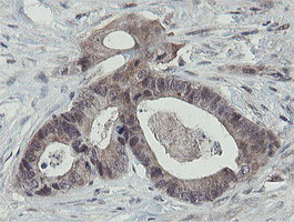 IHC of paraffin-embedded Adenocarcinoma of Human colon tissue using anti-OTUB1 mouse monoclonal antibody.