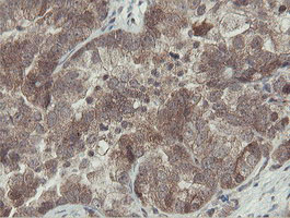 IHC of paraffin-embedded Adenocarcinoma of Human ovary tissue using anti-OTUB1 mouse monoclonal antibody.