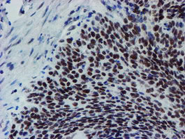 IHC of paraffin-embedded Carcinoma of Human bladder tissue using anti-METT10D mouse monoclonal antibody. (Heat-induced epitope retrieval by 10mM citric buffer, pH6.0, 100C for 10min).