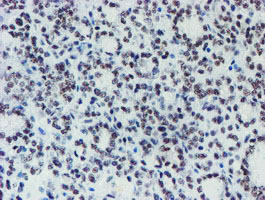 IHC of paraffin-embedded Carcinoma of Human thyroid tissue using anti-METT10D mouse monoclonal antibody. (Heat-induced epitope retrieval by 10mM citric buffer, pH6.0, 100C for 10min).