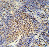 OTUD4 antibody immunohistochemistry of formalin-fixed and paraffin-embedded human lung carcinoma followed by peroxidase-conjugated secondary antibody and DAB staining.