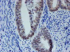 IHC of paraffin-embedded Adenocarcinoma of Human endometrium tissue using anti-METT10D mouse monoclonal antibody. (Heat-induced epitope retrieval by 10mM citric buffer, pH6.0, 100C for 10min).