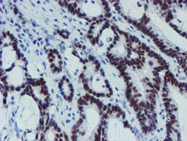 IHC of paraffin-embedded Adenocarcinoma of Human colon tissue using anti-METT10D mouse monoclonal antibody. (Heat-induced epitope retrieval by 10mM citric buffer, pH6.0, 100C for 10min).