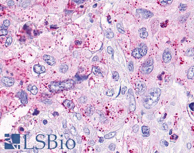 Anti-OXER1 antibody IHC of human Pancreas, Carcinoma. Immunohistochemistry of formalin-fixed, paraffin-embedded tissue after heat-induced antigen retrieval.