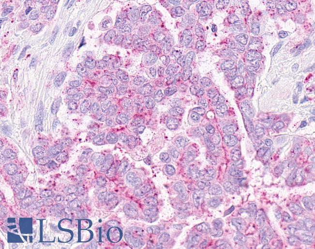 Anti-OXER1 antibody IHC of human Ovary, Carcinoma. Immunohistochemistry of formalin-fixed, paraffin-embedded tissue after heat-induced antigen retrieval.