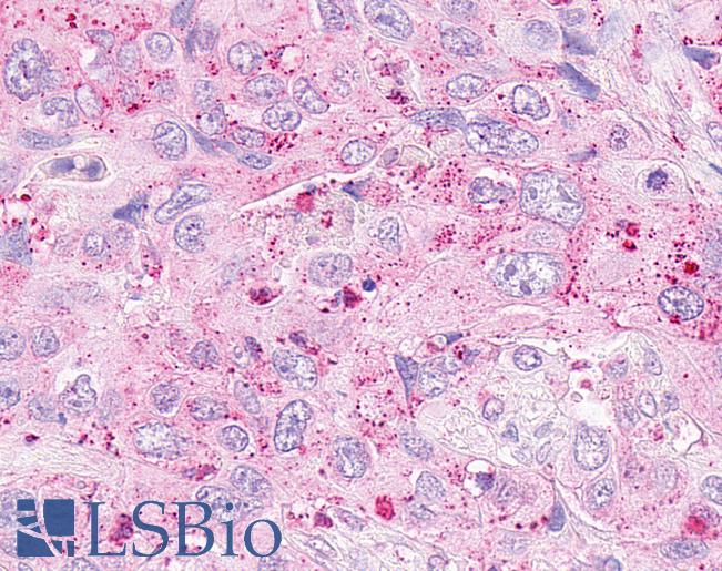 Anti-OXER1 antibody IHC of human Pancreas, Carcinoma. Immunohistochemistry of formalin-fixed, paraffin-embedded tissue after heat-induced antigen retrieval.