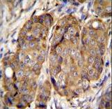 METTL2 Antibody immunohistochemistry of formalin-fixed and paraffin-embedded human breast carcinoma followed by peroxidase-conjugated secondary antibody and DAB staining.