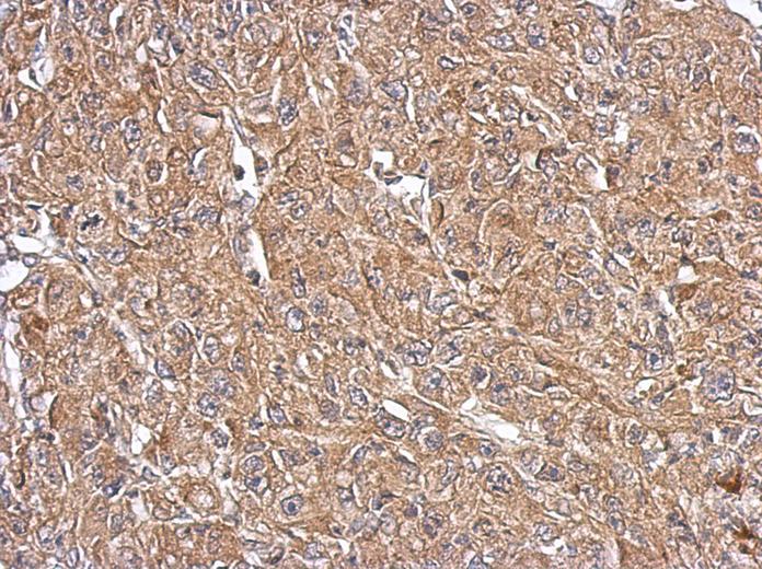 IHC of paraffin-embedded Mahlarvu xenograft, using OXSM antibody at 1:500 dilution.