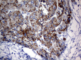IHC of paraffin-embedded Carcinoma of Human liver tissue using anti-OXSM mouse monoclonal antibody.