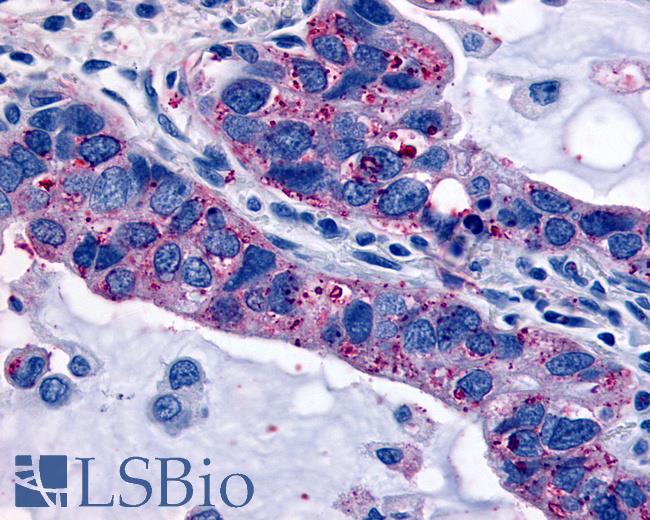 Anti-OXTR / Oxytocin Receptor antibody IHC of human Lung, Adenocarcinoma. Immunohistochemistry of formalin-fixed, paraffin-embedded tissue after heat-induced antigen retrieval.
