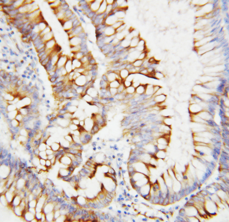 Osteonectin / SPARC antibody. IHC(P): Human Intestinal Cancer Tissue.