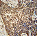 METTL4 antibody immunohistochemistry of formalin-fixed and paraffin-embedded human Lung carcinoma followed by peroxidase-conjugated secondary antibody and DAB staining.